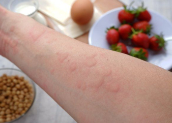Qida allergiyaları və intoleransları