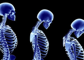 Osteoporoz göründüyündən daha təhlükəlidir!