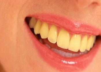 Hansı qidalar dişləri saraldır?