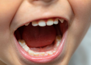 İlk dişlər niyə "süd dişləri" adlanır?
