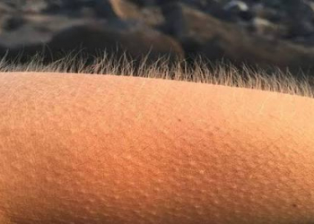 Bədəndə tüklərin ürpərməsinə səbəb nədir?