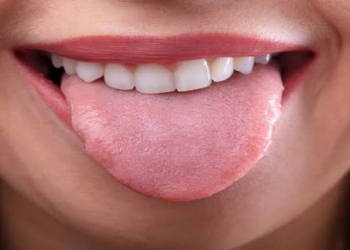 Dildəki yaralar nəyin əlaməti ola bilər?