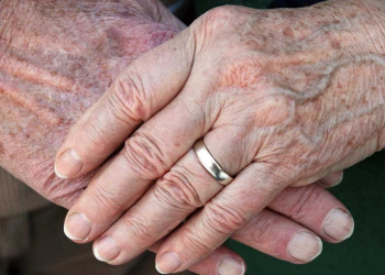 Gündə bir dəfə sürtün - Qocalıq ləkələrini yox edir