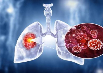 Ağciyər xərçənginin ilk əlaməti nədir?