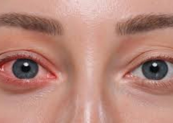 Yaz aylarında göz allergiyası hansı səbəblərdən olur?