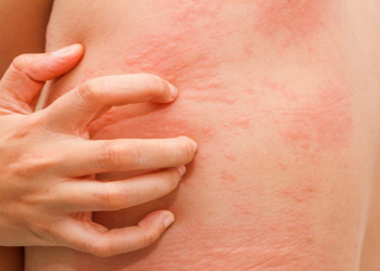 Yay aylarında allergik reaksiya niyə artır? – Dermatoloqdan xəbərdarlıq