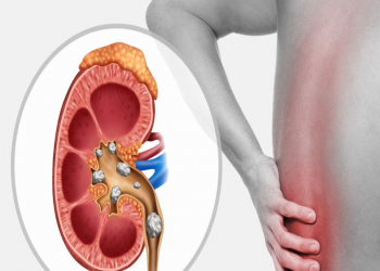 Hər gün bir ovuc yeyin: Böyrək daşlarını atmağa kömək edir
