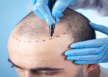 Həkim xəbərdarlıq edir: saç əkimi zamanı risklər tam istisna edilmir