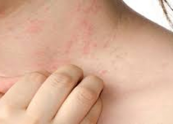 Yaz allergiyasına qarşı effektiv qorunma yolları açıqlanıb