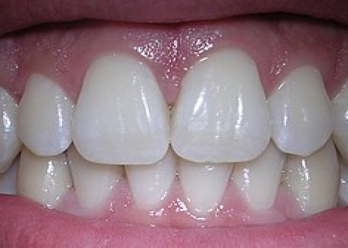 Dişləri qoruyan sadə vərdişlər sağlam təbəssümü uzun müddət saxlayır